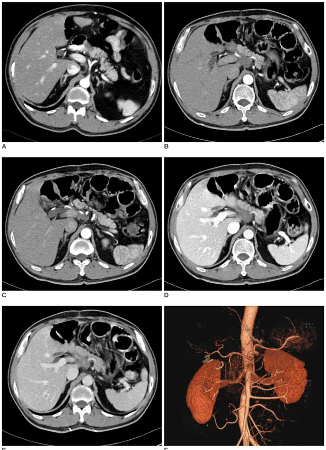 Fig. 1. A 56-year-old man with traumatic neuroma around the celiac trunk.