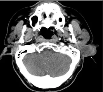 Fig. 2. Gross finding demonstrates a polypoid mass with attached skin, measuring 3.2×3.0×2.0 cm (A)