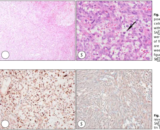 Fig. 3. Microscopic finding of low power field demonstrates  hyper-celluar spindle cell areas admixed with less cellular hyalinized zones ( A：H&amp;E stain, ×40)