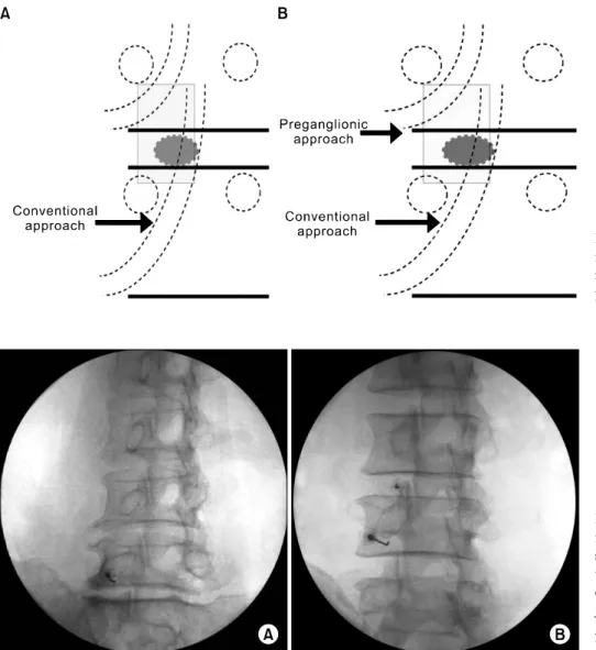 Fig.  1.  (A)  Schematic  diagram  show- show-ing  conventional  approach.  (B)   Sche-matic  diagram  showing  supplementary  preganglionic  approach.