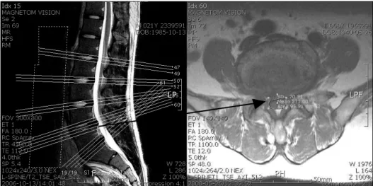 Fig.  1.  The  sagittal  and  axial  view  of  MRI  scan  slices,  arrow  indicates  the  DSCSA  (dural  sac  cross  sectional  area)  and  it  was  measured  at the  narrowest  level