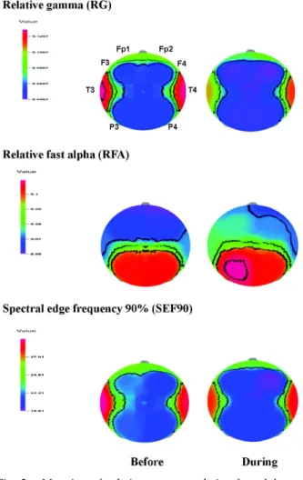 Fig. 2. t-Mapping of relative gamma, relative fast alpha and spectral edge frequency 90% brain waves before and during the inhalation of essential oil of M