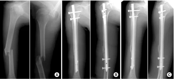Fig. 1. (A) Preoperative radiographs show anterior dislocation of right shoulder and comminuted fracture of the ipsilateral  humerus shaft