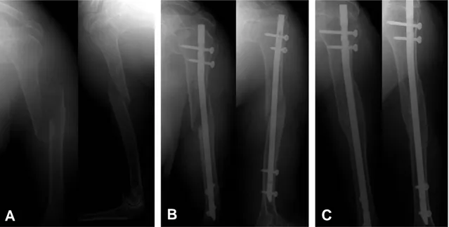 Fig. 2. 81-year-old female with left humerus shaft fracture underwent the operation of closed reduction and antegrade interlocking intramedullary nailing