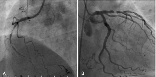 Fig. 1. Coronary angiography at pre-intervention. A: right coronary artery. B: left coronary artery