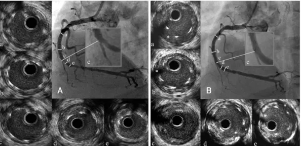 Fig. 3. Intravascular ultrasound (IVUS) images of sirolimus-eluting stent in right coronary artery (RCA)
