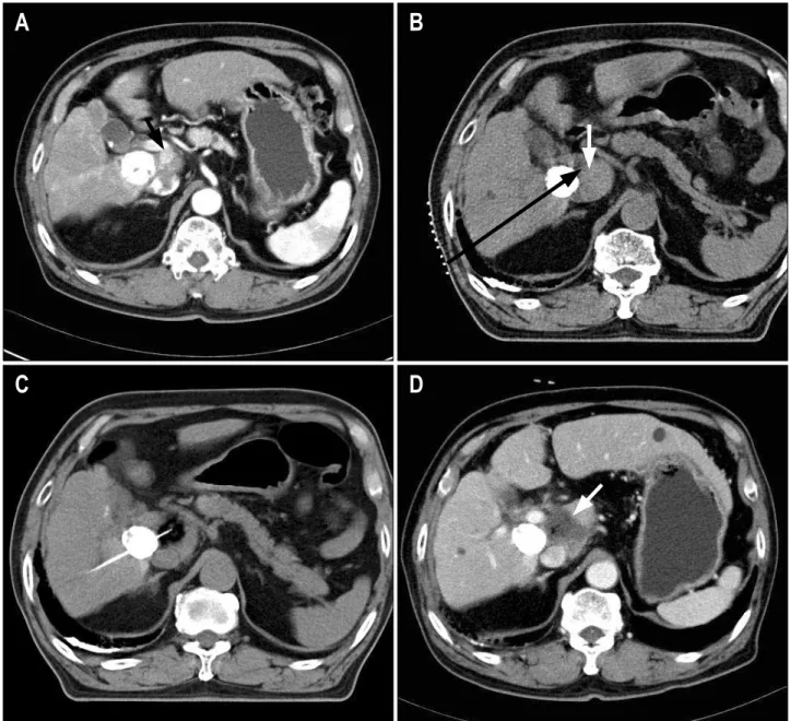 Fig. 1. Method of computed tomography (CT)-guided high-dose percutaneous ethanol injection (PEI) therapy in a 76-year-old man with viable hepatocellular carcinoma (HCC) in the caudate lobe of the liver in spite of repeated transcatheter arterial  chemoembo