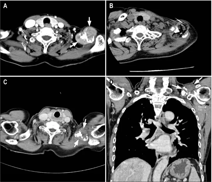 Fig. 3. Computed tomography (CT)-guided high-dose percutaneous ethanol injection (PEI) therapy in a 75-year-old woman with left  clavicle metastasis of hepatocellular carcinoma