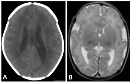 Fig. 2. Some  examples  of  magnetic  resonance  imaging  findings  in  infants  with  congenital  cytomegalovirus  infection