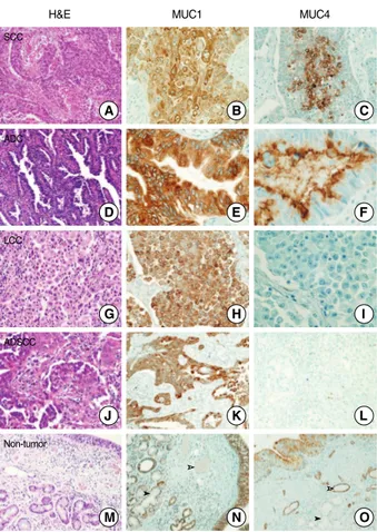 Fig. 2. Mucin (MUC)1 and MUC4 proteins show various expres- expres-sion patterns in different non-small cell lung carcinoma histologic subtype
