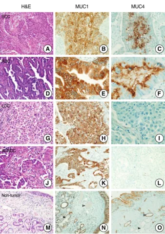 Fig. 2. Mucin (MUC)1 and MUC4 proteins show various expres- expres-sion patterns in different non-small cell lung carcinoma histologic subtype