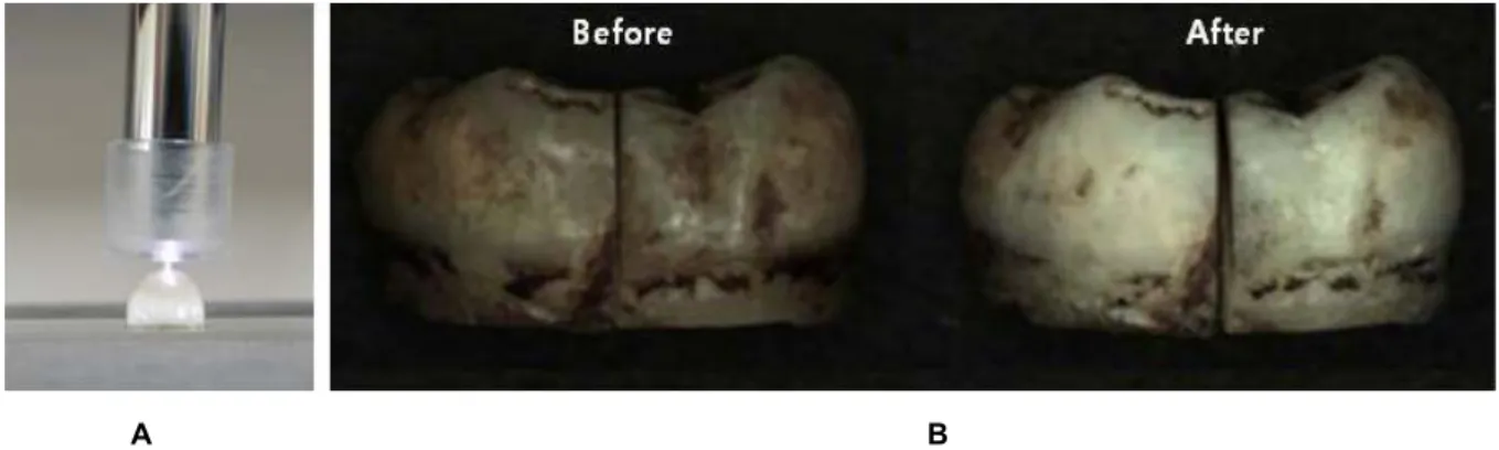 Fig. 3. The plasma tooth bleaching. The extracted human tooth was treated with 15% carbamideperoxide and plasma for 30 min (A)