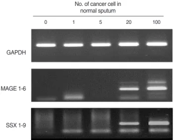 Table 2. Analysis of the profile of MAGE and SSX gene expression in sputum according to the pathology of head and neck cancer