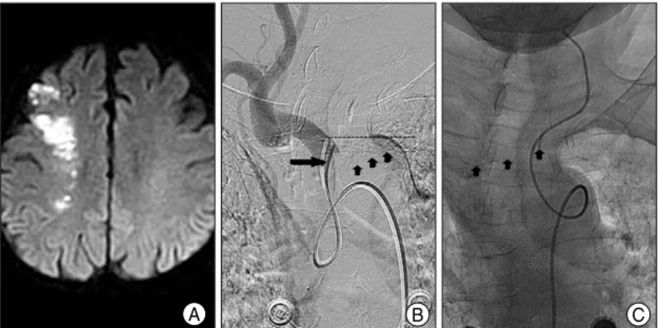 Fig. 1. A : Diffusion-weighted magnetic resonance image showing acute watershed infarction in the right hemisphere