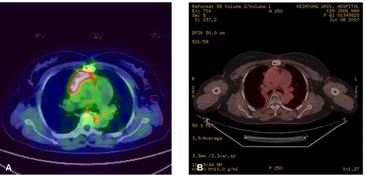 Figure 7. (A) Four months after surgical excision, follow up PET-CT scan showing increased FDG uptake of residual soft tissue.