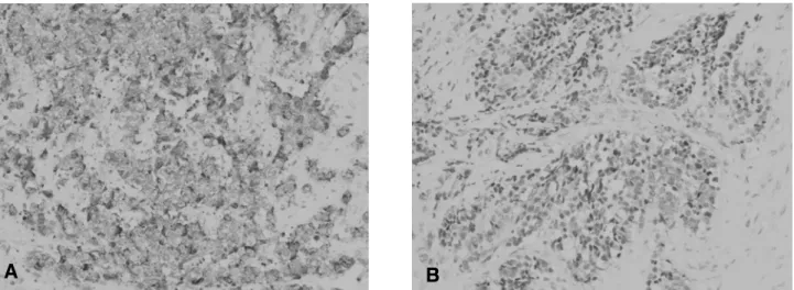 Figure 3. Immunohistochemical staining for chromogranin revealed strong positivity (A) and neuron specific enolase (NSE) revealed  focal positivity (B) (×400).