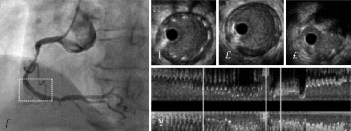 Fig. 2. Intravascular ultrasound image of the stent fracture site. Post-Stenting with (A) 4.0×20 mm