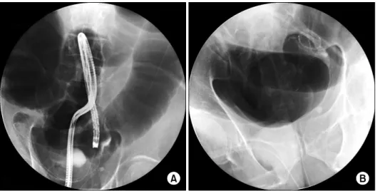 Fig.  3.  Radiograhpic  views  of  stent  placement.  (A)  Guide  wire  through  the  mass
