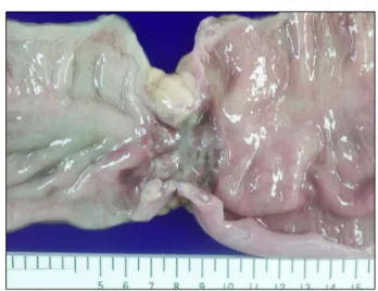 Fig.  5.  The  resected  specimen  shows  a  3  cm  sized  hard  obstructing  tumor.