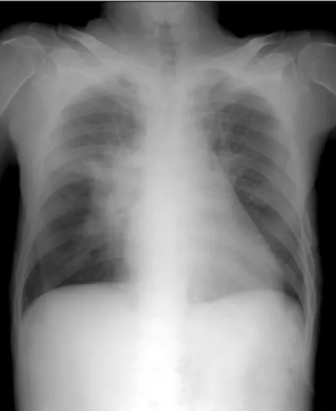 Figure  1.  Chest  X-ray  finding.  Right  hilar  area  shows  pneumonic  infiltration.