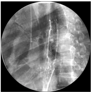 Figure  4.  Chest  X-ray  finding.  Follow-up  chest  film  reveals  improvement  of  pneumonic  infiltration  at  right  hilar  area.