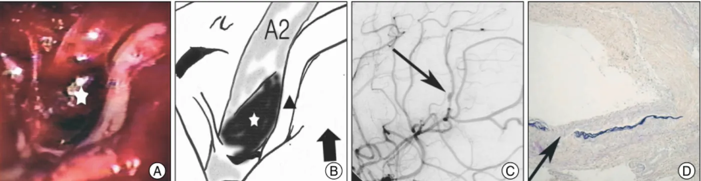 Fig. 2. Example of arterial dissection with intramural hemorrhage producing focal narrowing of vessel (A &amp; B) and rupture producing bleeding into brain (C &amp; D)