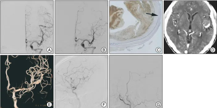 Fig. 4. Example of progress enlargement of dissection both laterally and longitudinally (A, B and C) and serpentine channel within dissected thrombotic aneurysm (D, E, F, and G)
