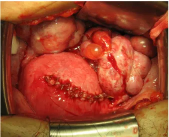 Fig. 3. Intramural pregnancy was excised and sutured by three  layer.  임신 산물을 제거한 후 결손부위를 3층으로 나누어 봉합하 였다 (Fig