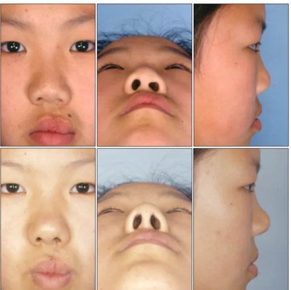 Fig. 4. Polyethylene group. (Above) Preoperative views. The columellar length index of cleft side to non-cleft side was 0.74.