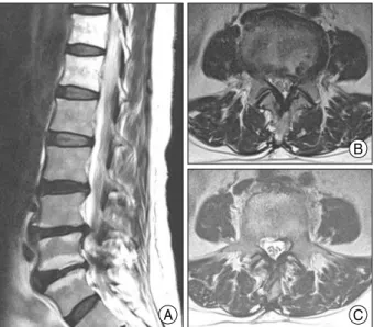 Fig. 2. Lumbar spine MRI. A : Sagittal T2WI of the second round of MRI shows almost complete regression of the herniated nucleus pulposus at the L4/5 level
