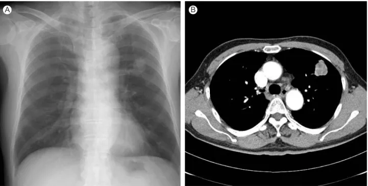 Figure 2. F18-fluorodeoxyglucose positron emission tomography (PET) fused coronal image; fusion PET demonstrates a moderately hypermetabolic mass in the left upper lobe.