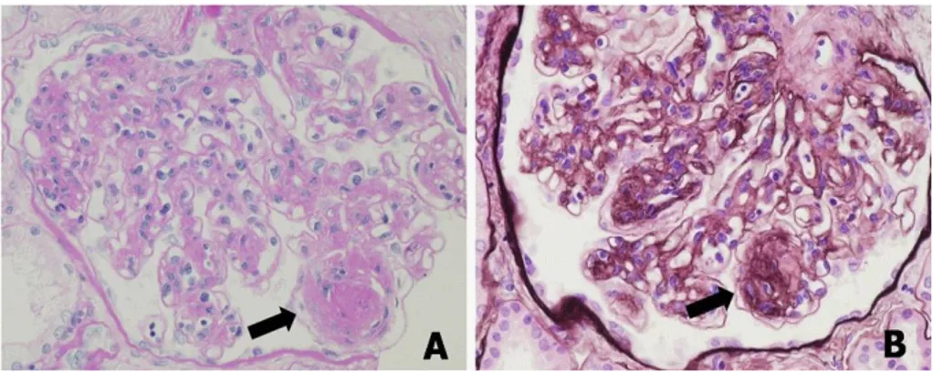 Fig. 1. The light microscopic finding of renal biopsy shows severe interstitial fibrosis and tubular atrophy (Masson Trichrome, × 60).
