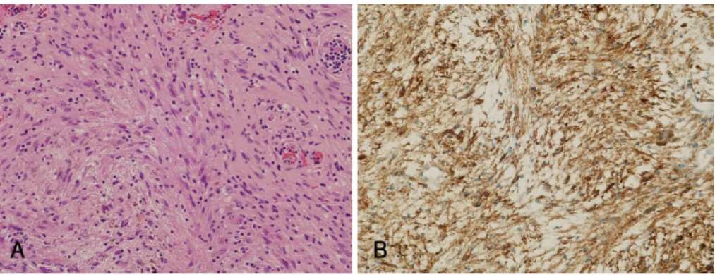 Fig. 4. Pathologic findings of speci- speci-men. Light microscopic appearance of tumor shows proliferation of many spindle cells with whorling pattern (Hematoxylin &amp; Eosin stain, ×200) (A)