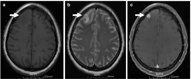 Fig. 1 a T1-weighted axial brain MR image showing a hypointense lesion (arrow) in the right frontal lobe and (b) T2-weighted axial brain MR image showing a hyperintense lesion (arrow) with edema in the