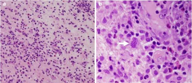 Fig. 3 a Pathologic examination shows inflammatory tissues infiltrated with lymphocytes, macrophages and plasma cells, areas with microglial nodules and lymphocytic perivascular infiltration and hyalinization, and