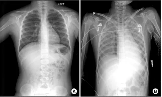 Fig.  1.  Preoperative  (A)  chest  radio- radio-graph  shoaws  clear  lung  field,  but  postoperative  (B)  chest  radiograph  shows  diffuse  bilateral  infiltration.