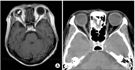 Fig.  1.  (A)  Pre-RT  Gd-enhanced  T1-  axial  brain  MRI,  7  mm  in  thickness,  reveals  a  focal  nodular  enhancing  mass  (arrow)  at  the  posterosuperior  wall  of  right  eyeball