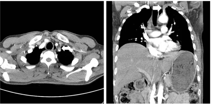 Fig. 2. Chest CT* shows segmental occlusion in left subclavian artery (arrow).