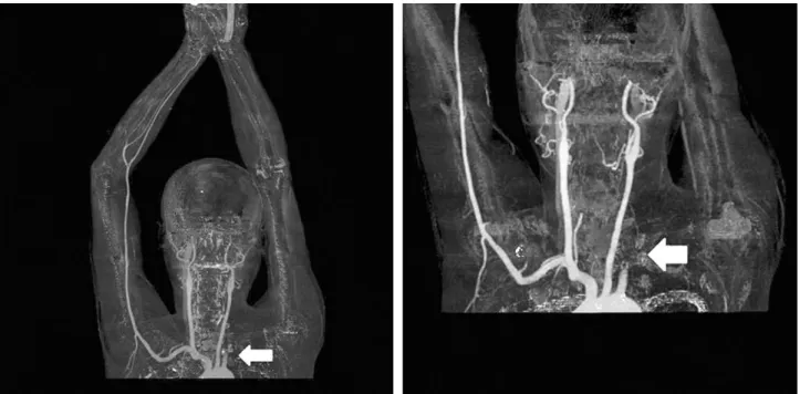 Fig. 3. Upper extremities CT angiography show segmental occlusion in left subclavian artery and axillary artery (arrow).