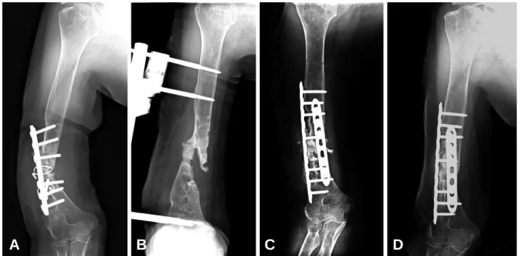 Fig. 1. 78-year-old woman with humerus shaft infected nonunion underwent the operation of open reduction and internal fixation using dual LCP fixation and autogeneous iliac bone graft