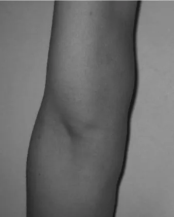 Fig. 2. (A) Coronal T1-weighted MR image shows that the mass has a isointensity signal relative to muscle.