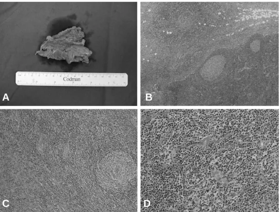 Fig. 3. (A) Gross findings of the specimen shows a gray-pinkish, fleshy, ill-defined lesion that blended into the surrounding subcutaneous fat