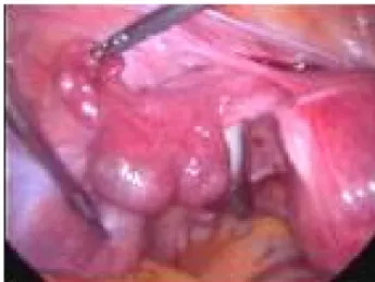Fig. 2. At the time of laparoscopy, two sacculed mass on left tube  was found. The left tube was not ruptured or there was no active  bleeding from the tube