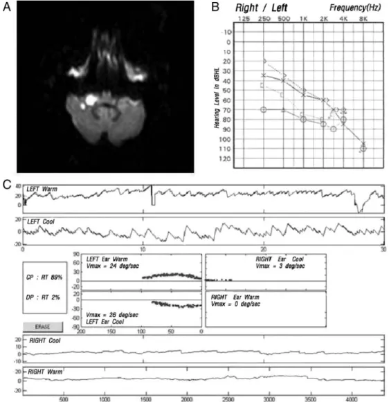 Figure 1. MRI and audiovestibular findings in a patient with AICA territory infarction and audiovestibular loss (Group 1)