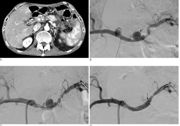 Fig. 1. 47-year-old man with stent-graft related splenic artery rupture.