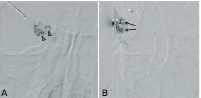 Fig. 1. Dacryocystography shows an uneven, mottled density of  contrast media, evidence of a soft tissue mass (A: blue arrow, B: 