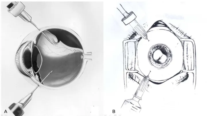 Fig. 1. (A) Technique for the pars plana approach to fluid-gas exchange using two 1 mL syringes for retinal detachment in a vitrectomized eye