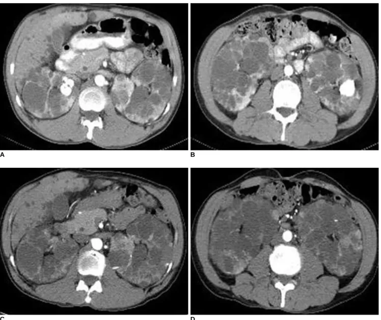 Fig. 2. 52-year-old man with autosomal dominant polycystic kidney disease and who underwent cyst ablation.