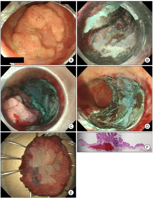 Figure 1. Endoscopic submucosal  dissection. (A) The  colo-noscopic image shows a 40 mm sized laterally  spreading tumor with  gra-nular surface at sigmoid  colon