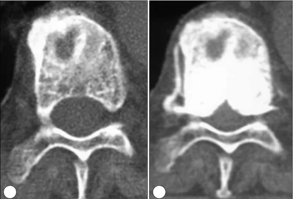 Fig. 1. A：Axial CT scan showing wedge compression fracture of vertebral body with double-contoured margin of the body